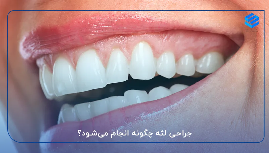 جراحی لثه چگونه انجام می‌شود؟