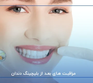 حفظ زیبایی لبخند با مراقبت های بعد از بلیچینگ دندان