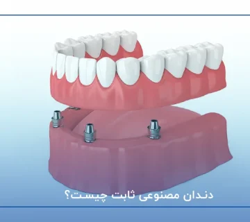 دندان مصنوعی ثابت چیست؟