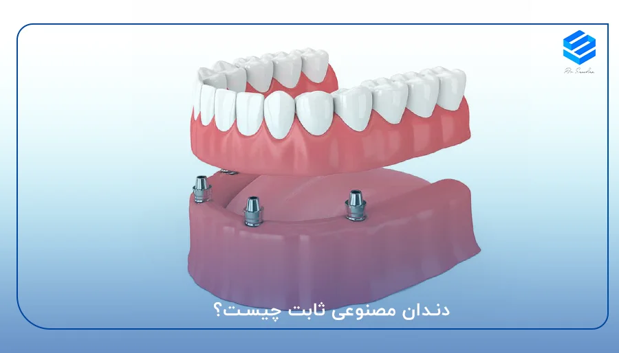 دندان مصنوعی ثابت چیست؟