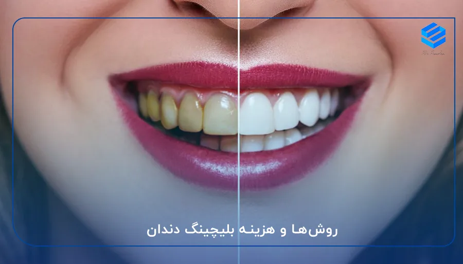 روش و هزینه بلیچینگ دندن