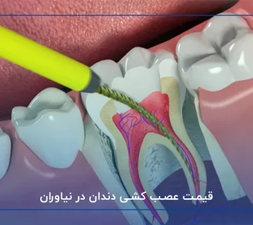 قیمت عصب کشی دندان در نیاوران
