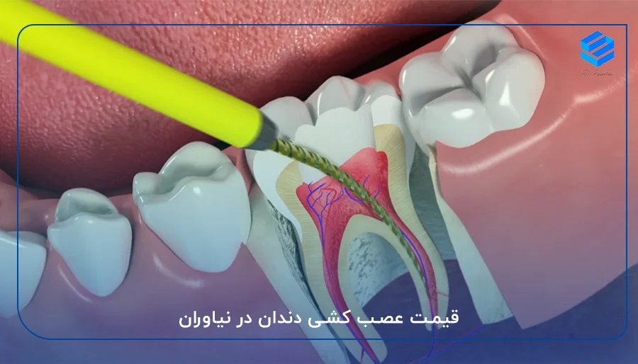 قیمت عصب کشی دندان در نیاوران