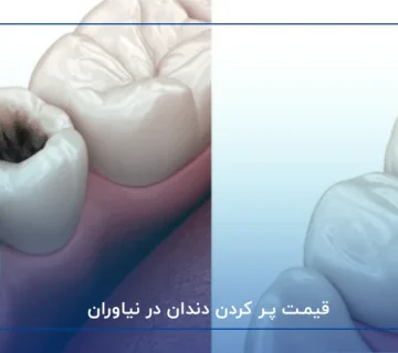 قیمت پر کردن دندان در نیاوران