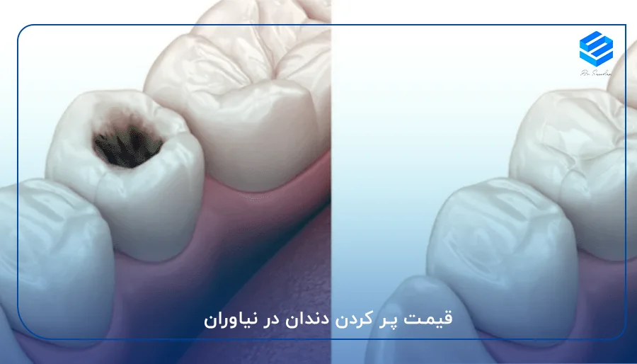 قیمت پر کردن دندان در نیاوران