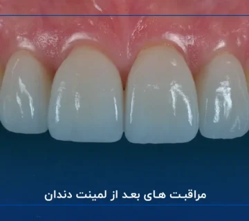مراقبت های بعد از لمینت دندان