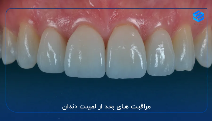 مراقبت های بعد از لمینت دندان
