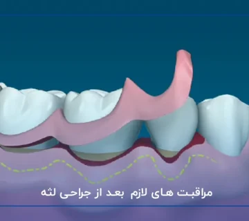 مراقبت های لازم بعد از جراحی لثه