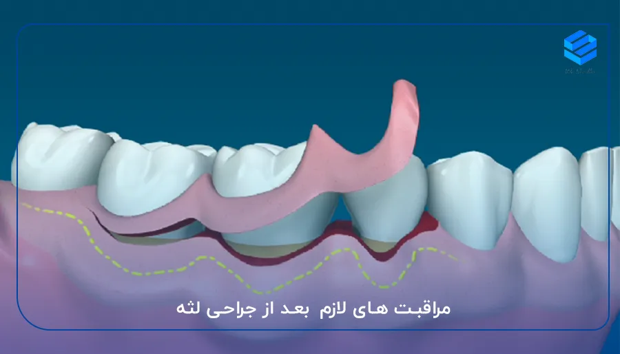 مراقبت های لازم بعد از جراحی لثه