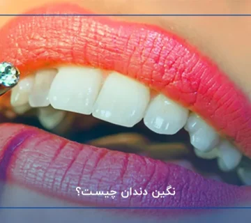 نگین دندان چیست؟