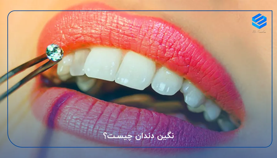 نگین دندان چیست؟