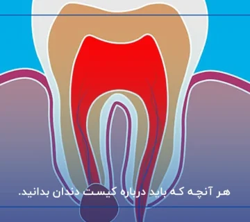 هر آنچه که باید درباره کیست دندان بدانید.