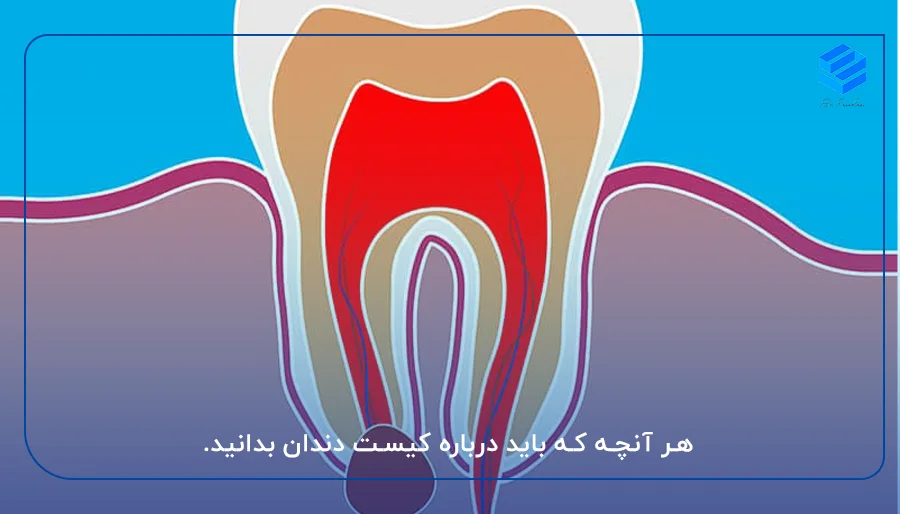 هر آنچه که باید درباره کیست دندان بدانید.