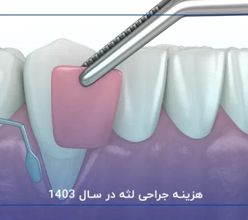 هزینه جراحی لثه در سال 1403