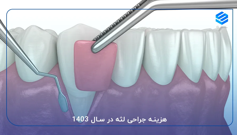 هزینه جراحی لثه در سال 1403