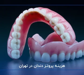 هزینه پروتز دندان در تهران