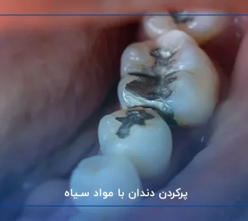 پرکردن دندان با مواد سیاه