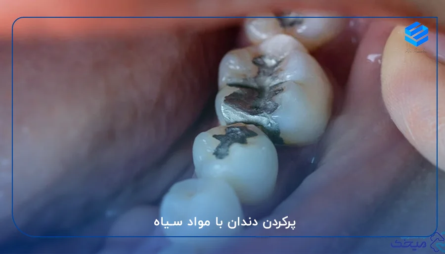 پرکردن دندان با مواد سیاه