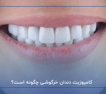 کامپوزیت دندان خرگوشی