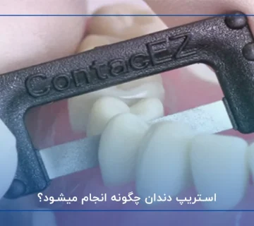 استریپ دندان چگونه انجام میشود؟