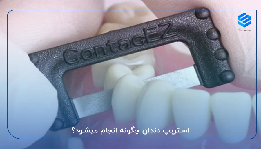 استریپ دندان چگونه انجام میشود؟