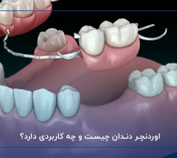 اوردنچر دندان چیست و چه کاربردی دارد؟