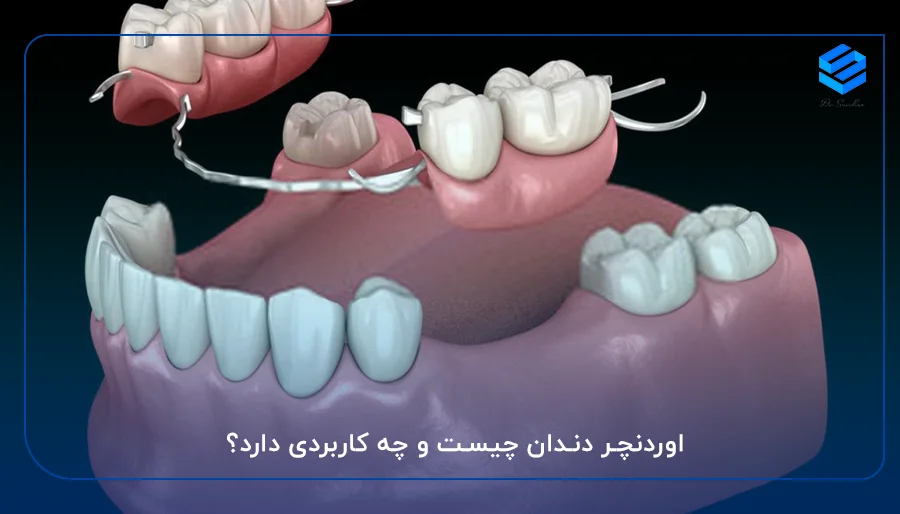 اوردنچر دندان چیست و چه کاربردی دارد؟