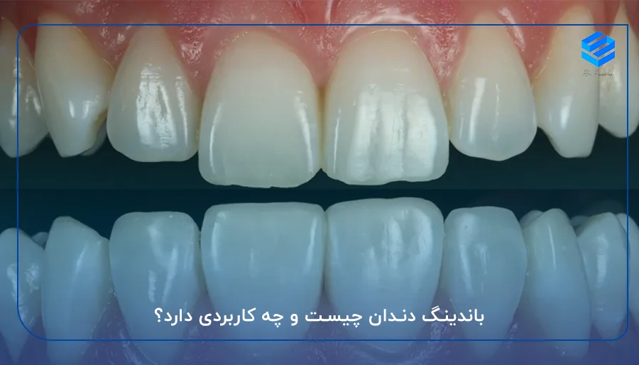 باندینگ دندان چیست و چه کاربردی دارد