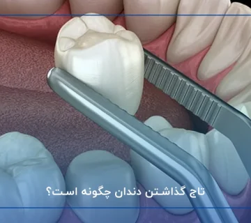 تاج گذاشتن دندان چگونه است؟