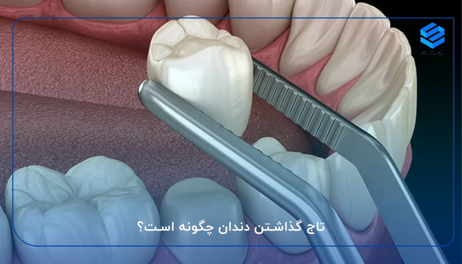 تاج گذاشتن دندان چگونه است؟