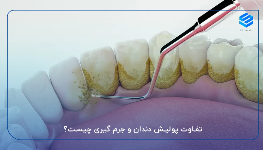 تفاوت پولیش دندان و جرم گیری چیست؟