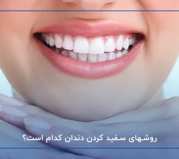 روشهای سفید کردن دندان کدام است؟