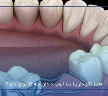 فضا نگهدار یا بند لوپ دندان چه کاربردی دارد؟