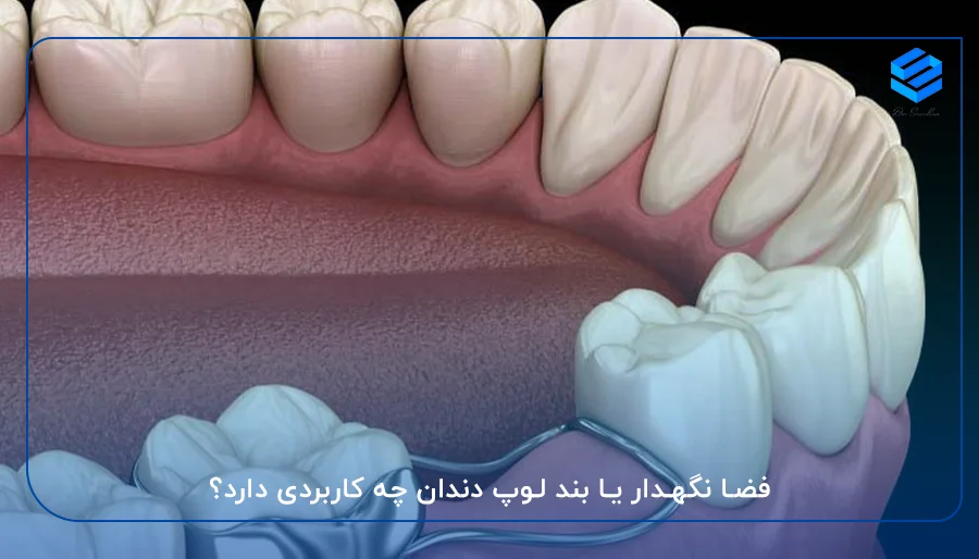 فضا نگهدار یا بند لوپ دندان چه کاربردی دارد؟