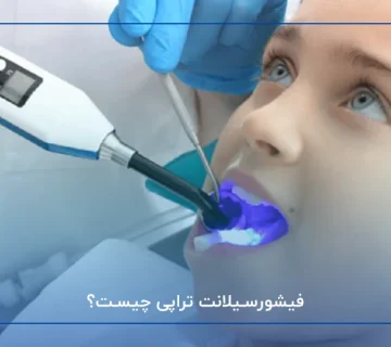 فیشورسیلانت تراپی چیست؟