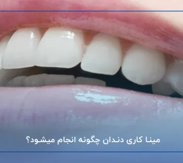 مینا کاری دندان چگونه انجام میشود؟