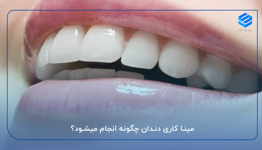 مینا کاری دندان چگونه انجام میشود؟