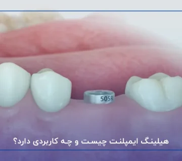 هیلینگ ایمپلنت چیست و چه کاربردی دارد؟