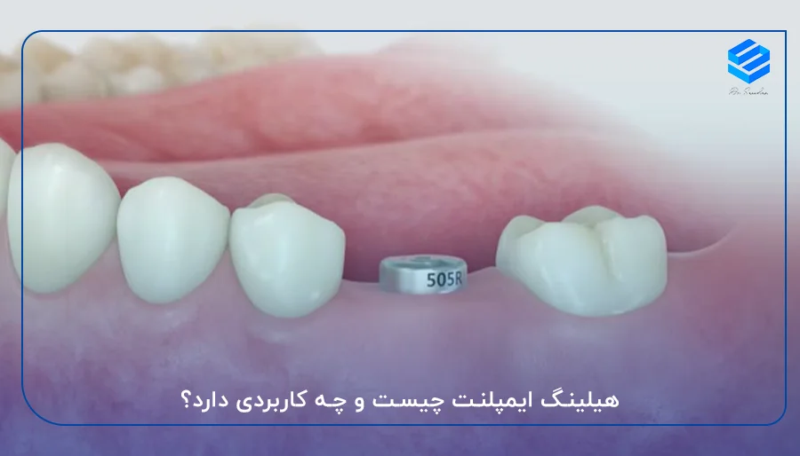 هیلینگ ایمپلنت چیست و چه کاربردی دارد؟