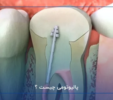 پالپوتومی چیست ؟
