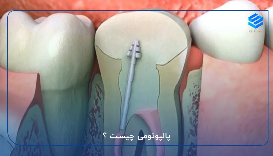 پالپوتومی چیست ؟