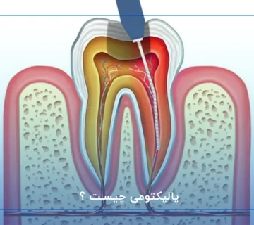 پالپکتومی چیست ؟