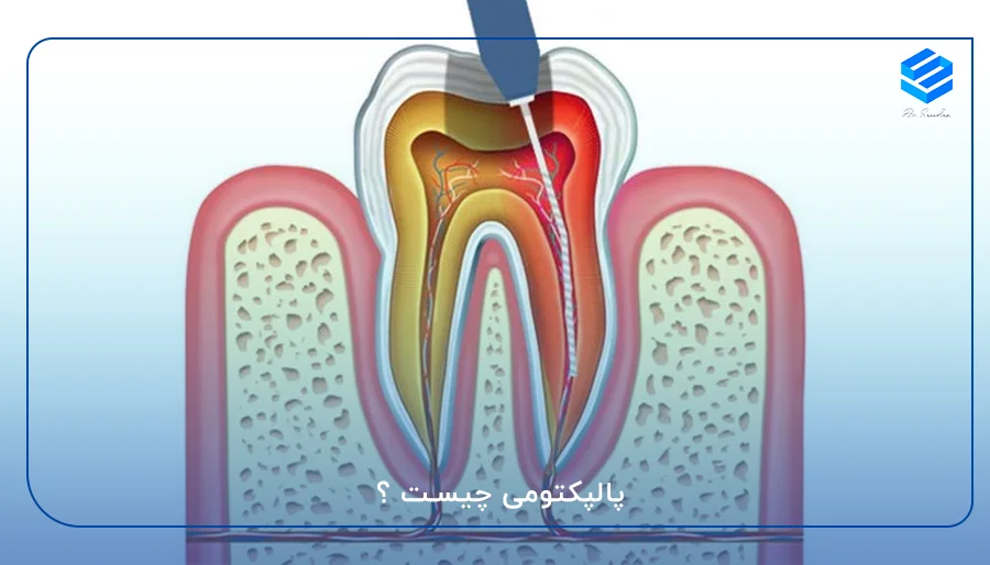 پالپکتومی چیست ؟