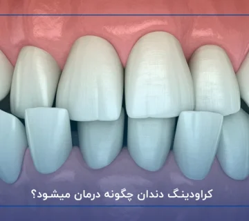 کراودینگ دندان چگونه درمان میشود؟
