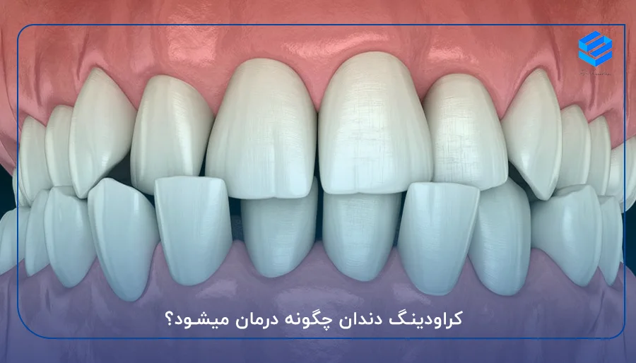 کراودینگ دندان چگونه درمان میشود؟