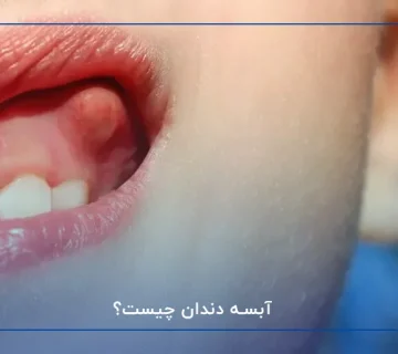 آبسه دندان چیست؟