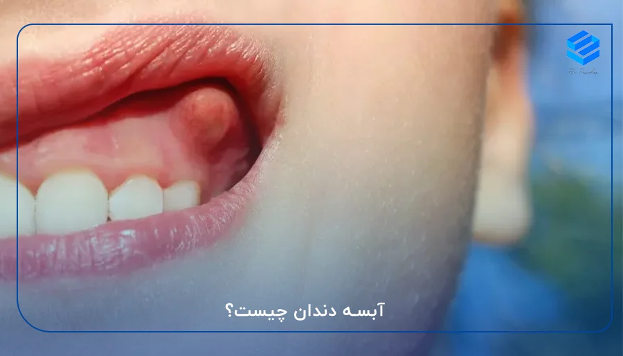 آبسه دندان چیست؟