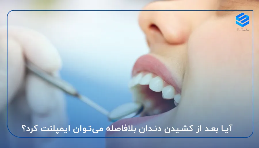 آیا بعد از کشیدن دندان بلافاصله می‌توان ایمپلنت کرد