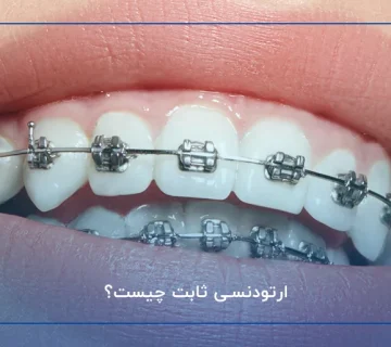 ارتودنسی ثابت چیست؟