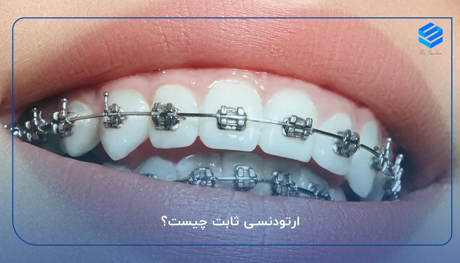 ارتودنسی ثابت چیست؟